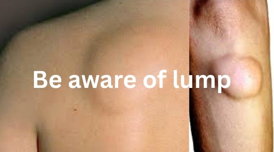 Sarcoma- the Complexities of Rare Connective Tissue Malignancies