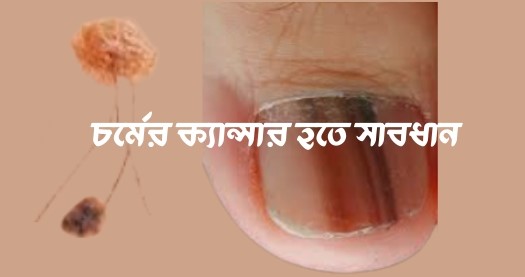 মেলানোমা: সবচেয়ে আক্রমণাত্মক ত্বকের ক্যান্সার